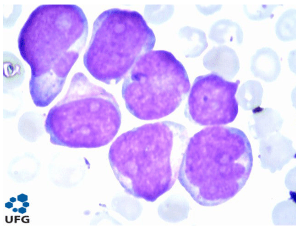 Tipos de leucemia: classificação, características e diferenças&nbsp;clínicas